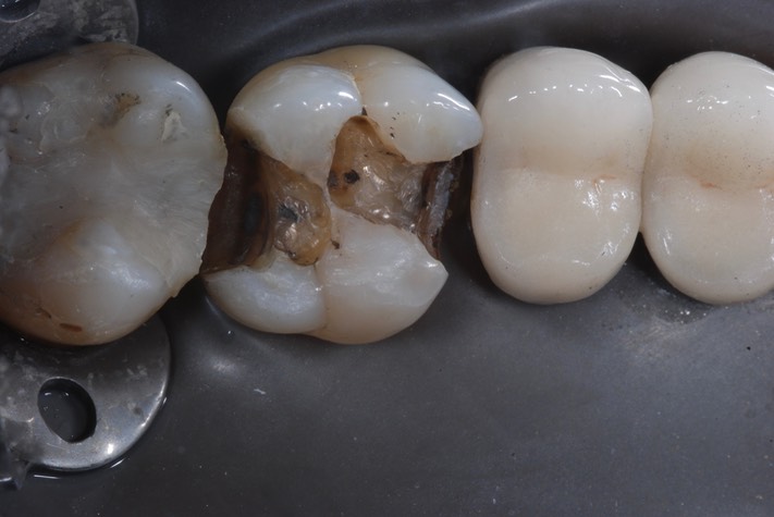 Kyle Chock #14 amalgam removal