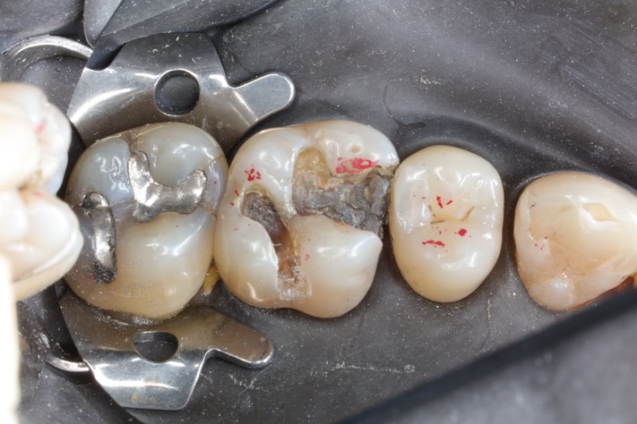 Kyle Chock #14 caries removal