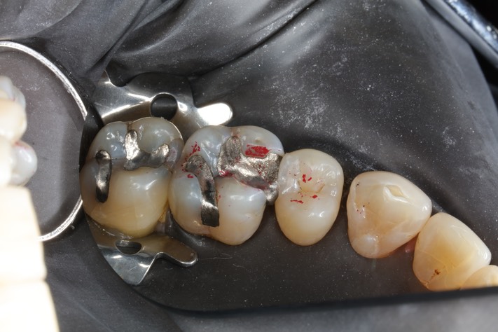 Kyle Chock #14 pre-op