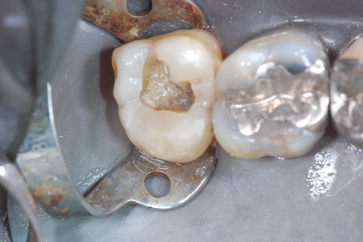 Kyle Chock #15 caries removal