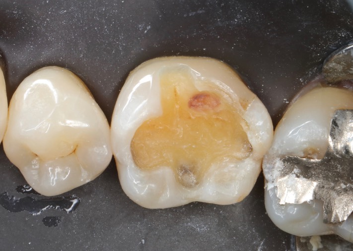 Kyle Chock #19 caries removal