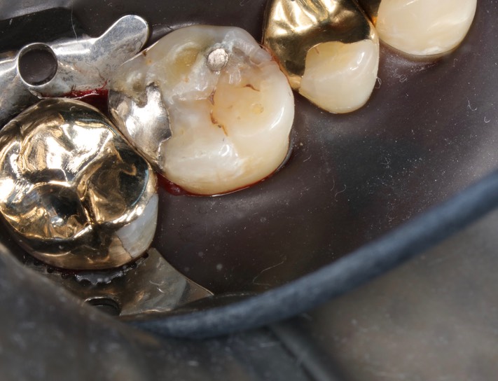 Kyle Chock #2 buccal view