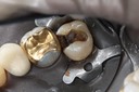 Kyle Chock #2 caries removal