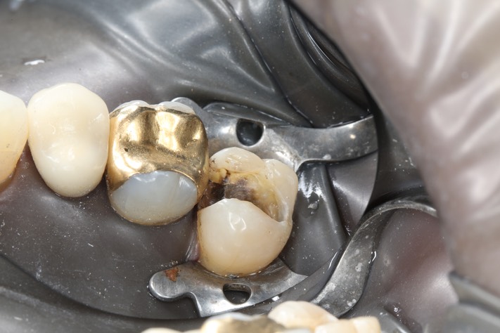 Kyle Chock #2 caries removal