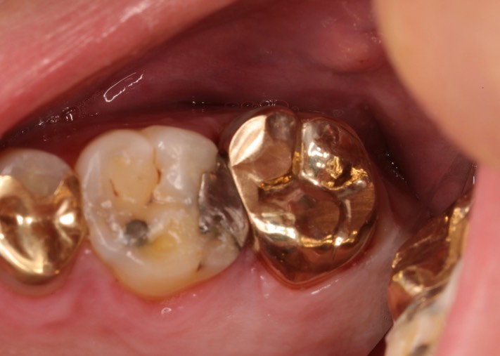 Kyle Chock #2 pre-cementation