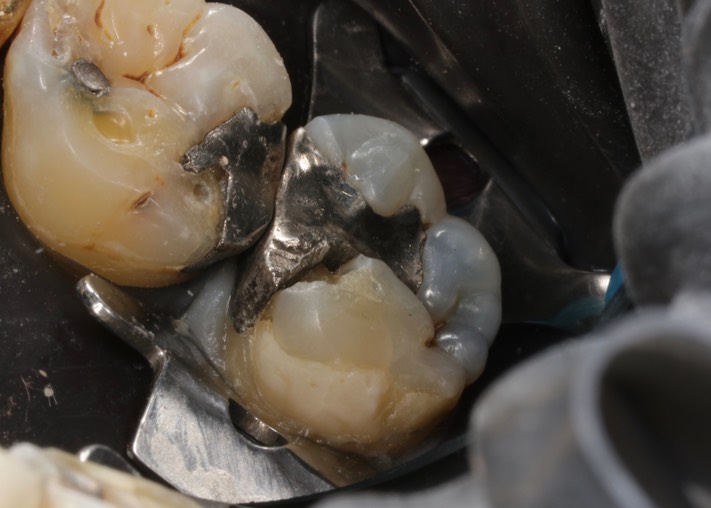 Kyle Chock #2 pre-op 