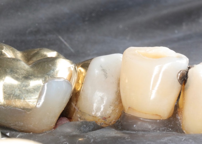 Kyle Chock #20 buccal view