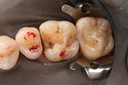 Kyle Chock #3 caries removal