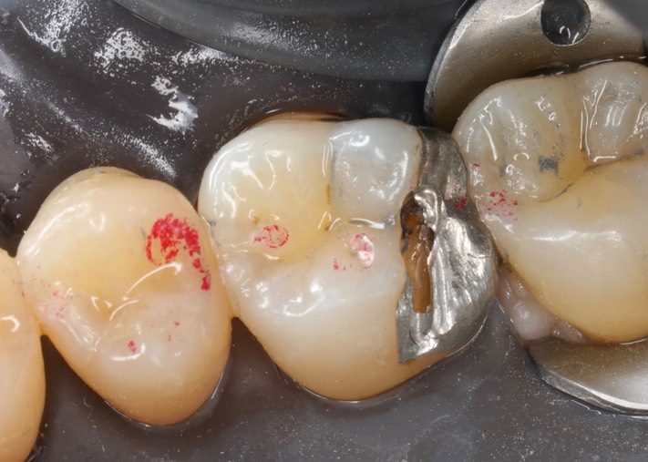 Kyle Chock #3 pre-op 