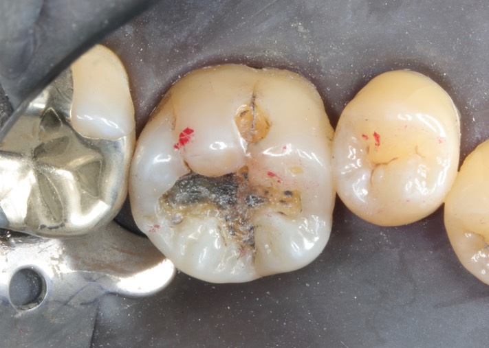 Kyle Chock #30 amalgam removal