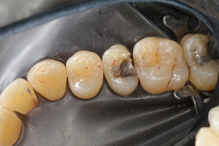 Kyle Chock #4 amalgam removal