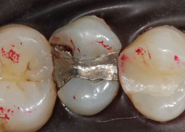 Kyle Chock #4 pre-op