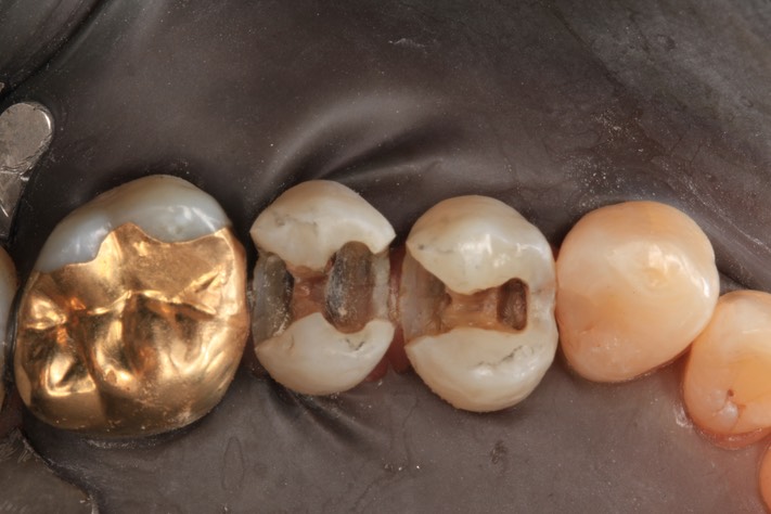 Kyle Chock #12-13 caries removal