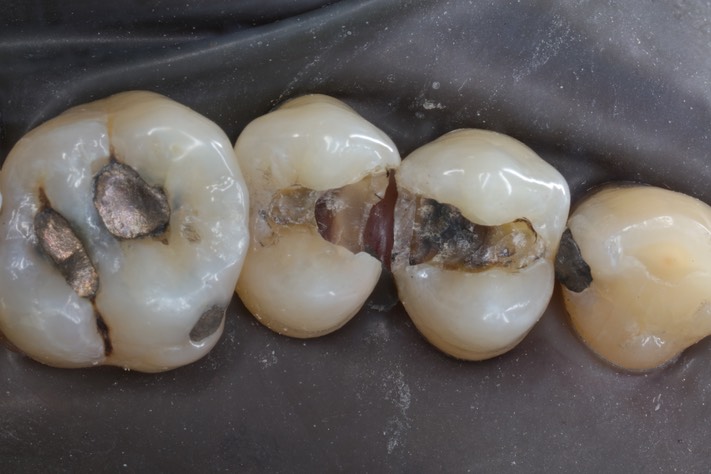 Larry Fujioka #12-13 amalgam removal