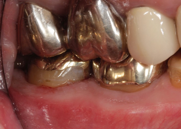 Larry Fujioka #13 buccal view