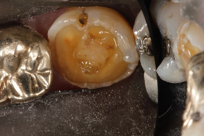 Larry Fujioka #18 caries removal