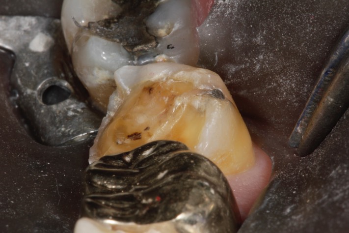 Larry Fujioka #18 pre-op