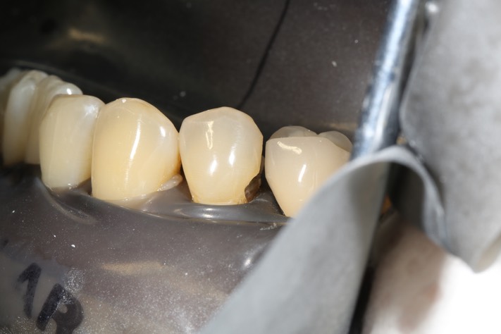 Larry Fujioka #21 buccal view