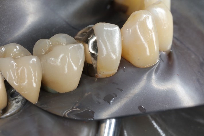 Larry Fujioka #21 finish buccal