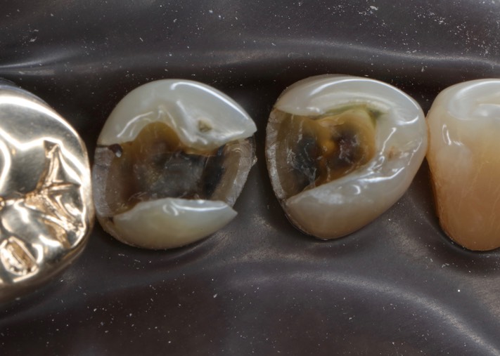 Larry Fujioka #28-29 amalgam removal