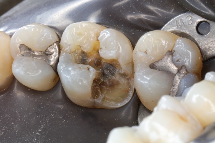 Larry Fujioka #3 amalgam removal