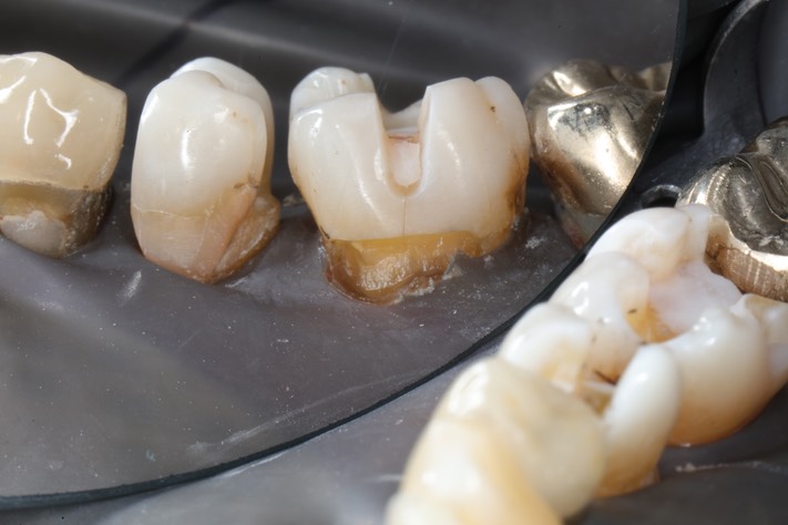 Larry Fujioka #30 buccal prep