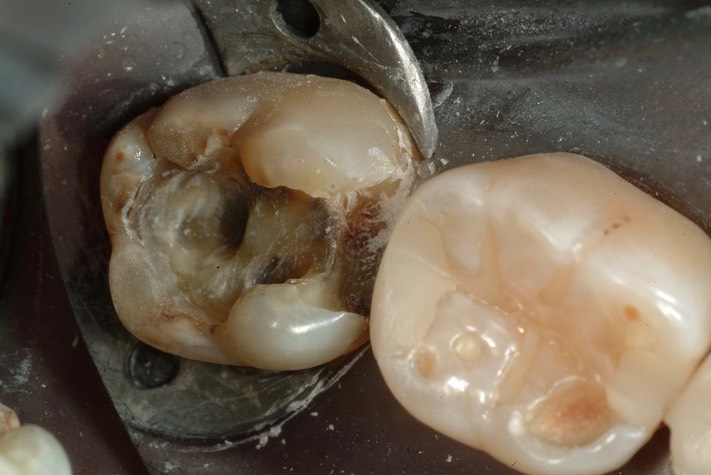 Larry Fujioka #31 caries removal