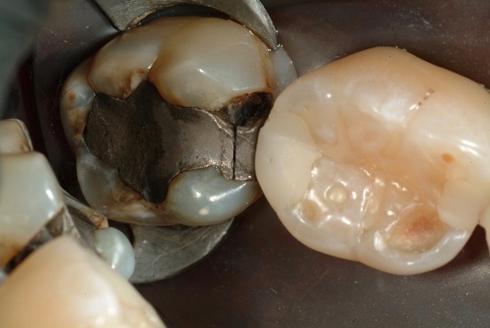 Larry Fujioka #31 pre-op