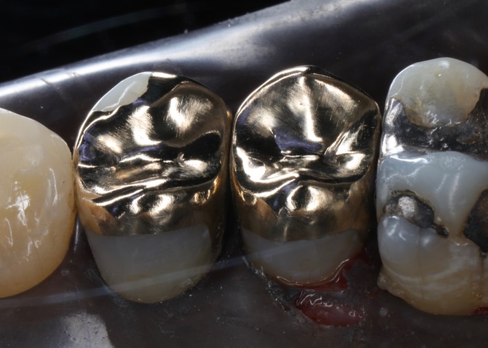 Larry Fujioka #4-5 lingual view