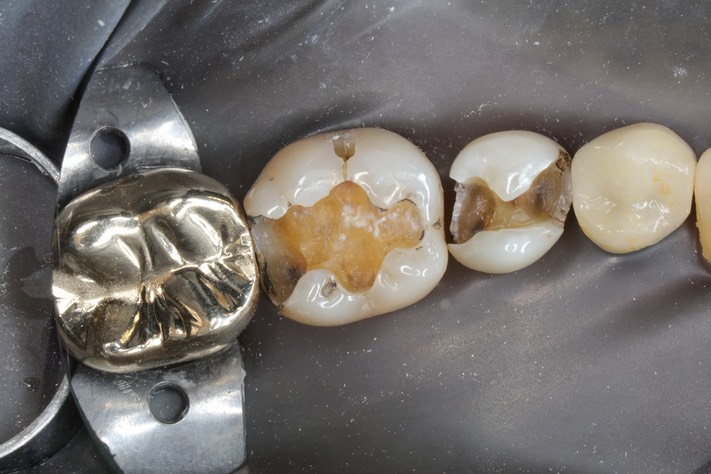 Larry Fujioka#29-30 amalgam removal