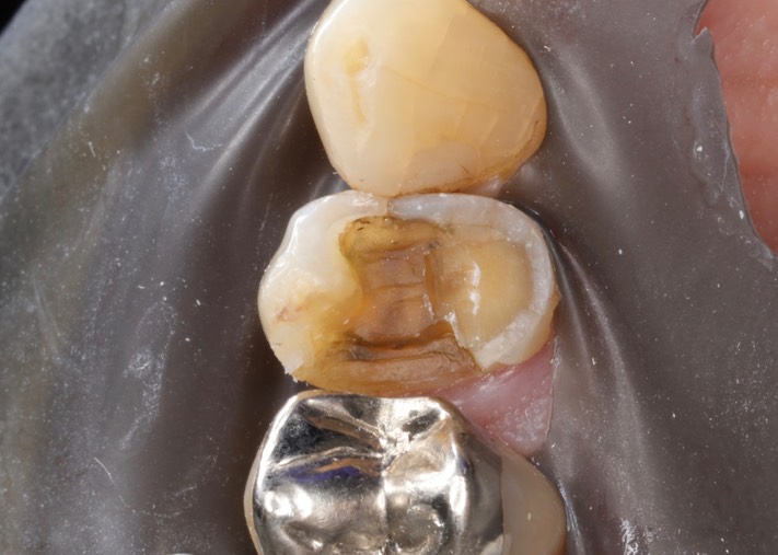 Mark Chun #12 amalgam removal