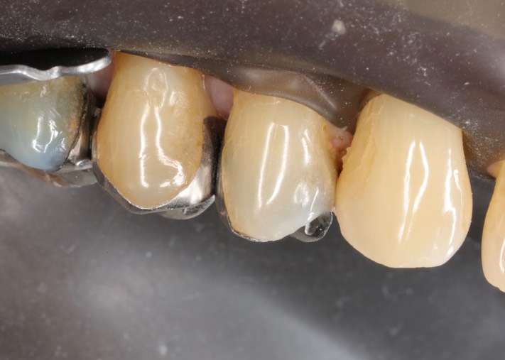 Mark Chun #12 buccal view