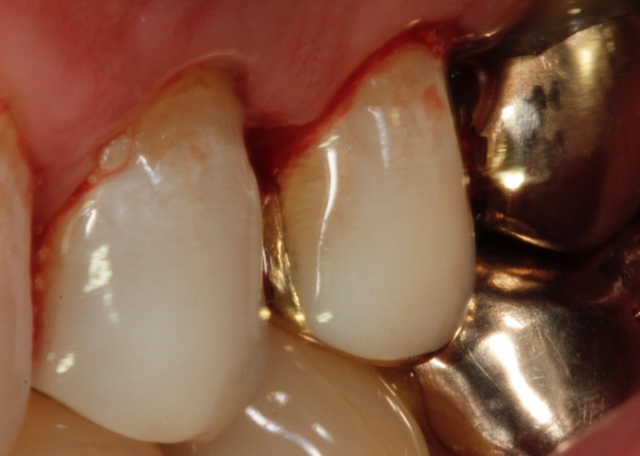 Mark Chun #13 buccal view