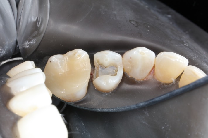 Mark Chun #13 composite removal