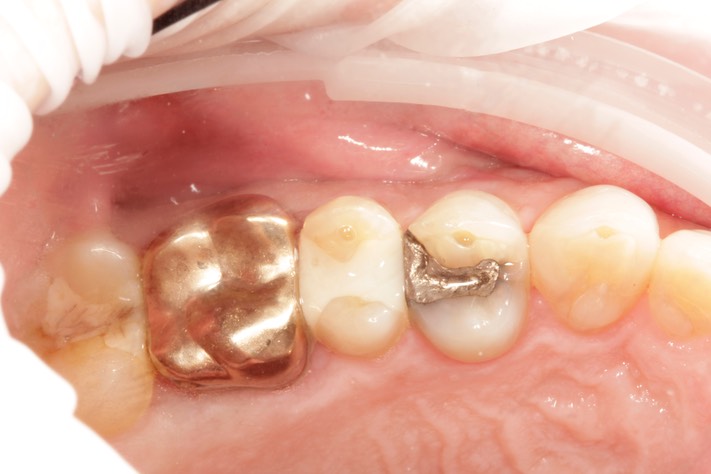 Mark Chun #13 pre-op 