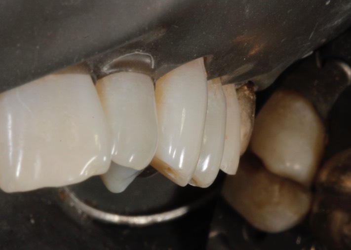Mark Chun #13 prep buccal view