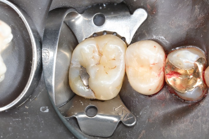 Mark Chun #14 pre-op