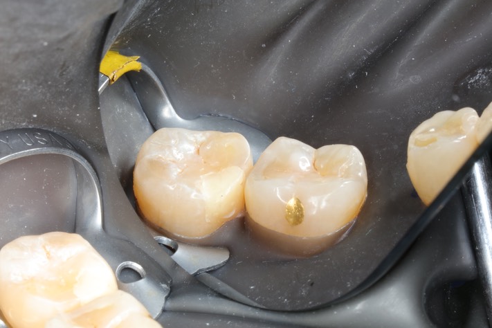 Mark Chun #17 pre-op