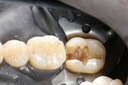 Mark Chun #19 caries removal