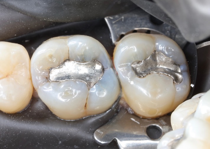 Mark Chun #2 & 3 pre-op