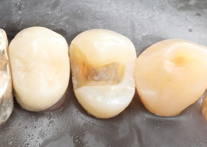 Matt Dodson #12 composite removal