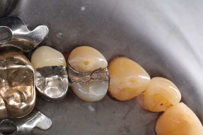 Matt Dodson #12 pre-op