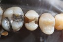 Matt Dodson #13 caries removal