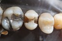 Matt Dodson #13 caries removal