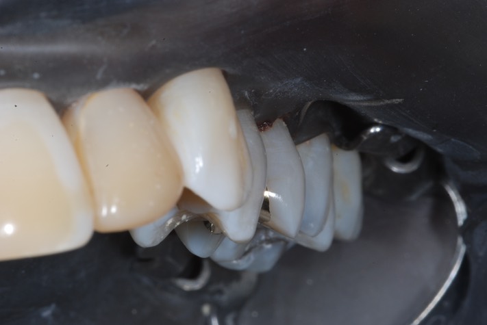 Matt Dodson #13 finish buccal view