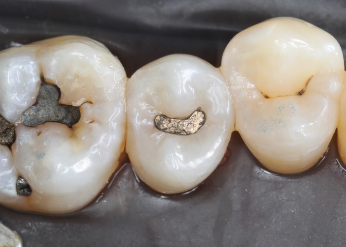 Matt Dodson #13 pre-op