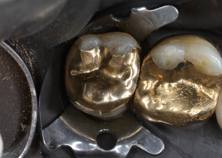 Matt Dodson #15 pre-cementation