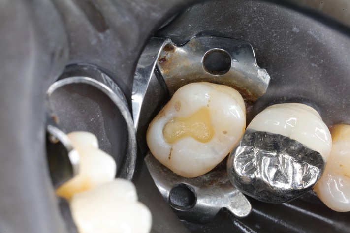 Matt Dodson #15 prep