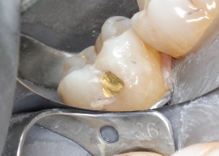 Matt Dodson #18 foil finish