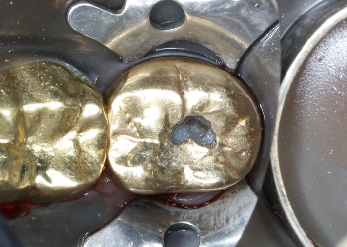 Matt Dodson #18 foil removal